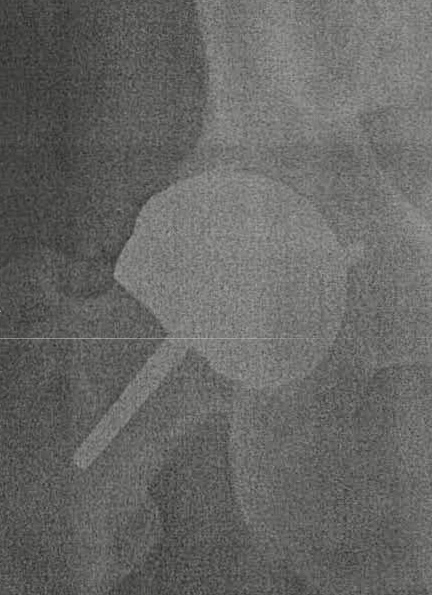 My Right Hip done in 2006